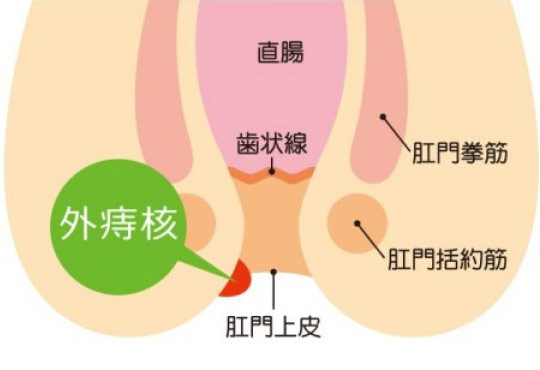 いぼ痔(痔核)