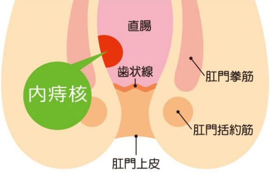 いぼ痔(痔核)