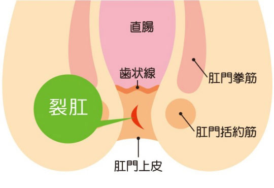 切れ痔(裂肛)