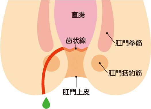 痔ろう(穴痔)