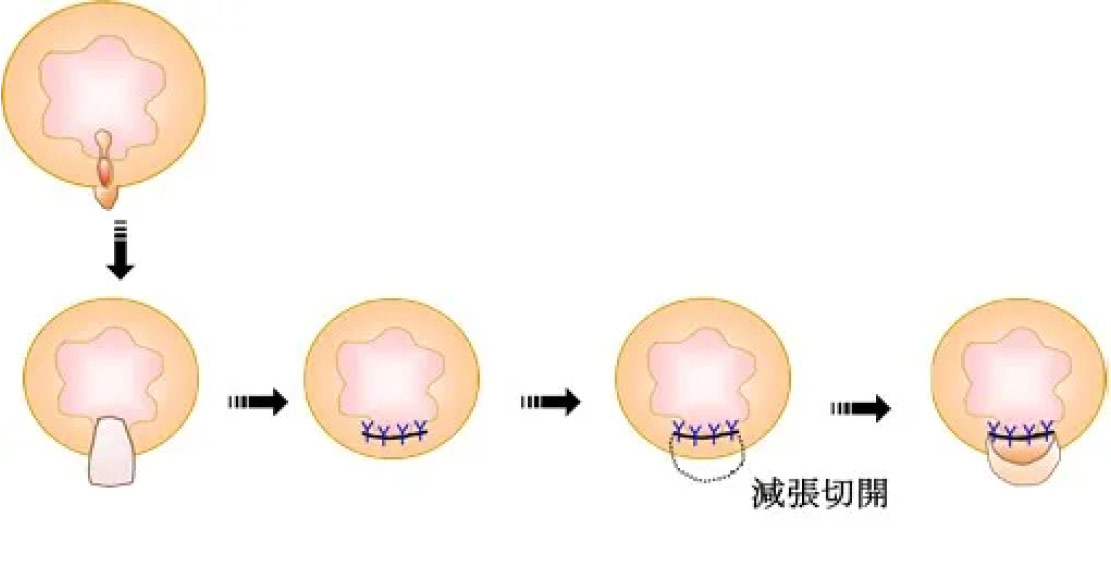 肛門形成術 (SSG法)