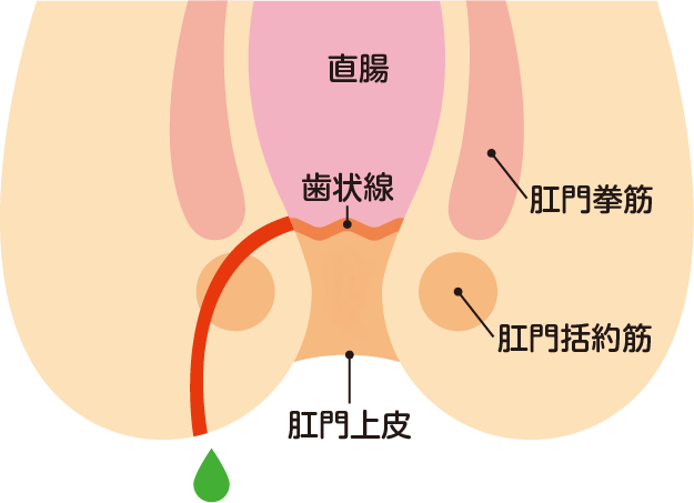 痔ろうとは？