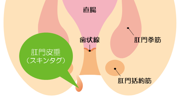 スキンタグ(肛門ひすい)について