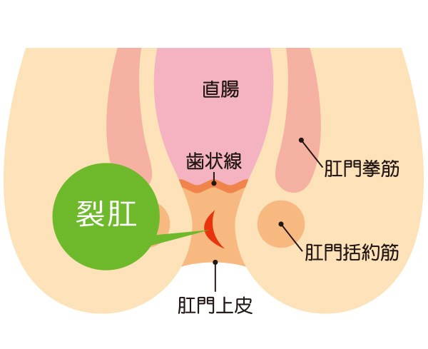 裂肛とは？