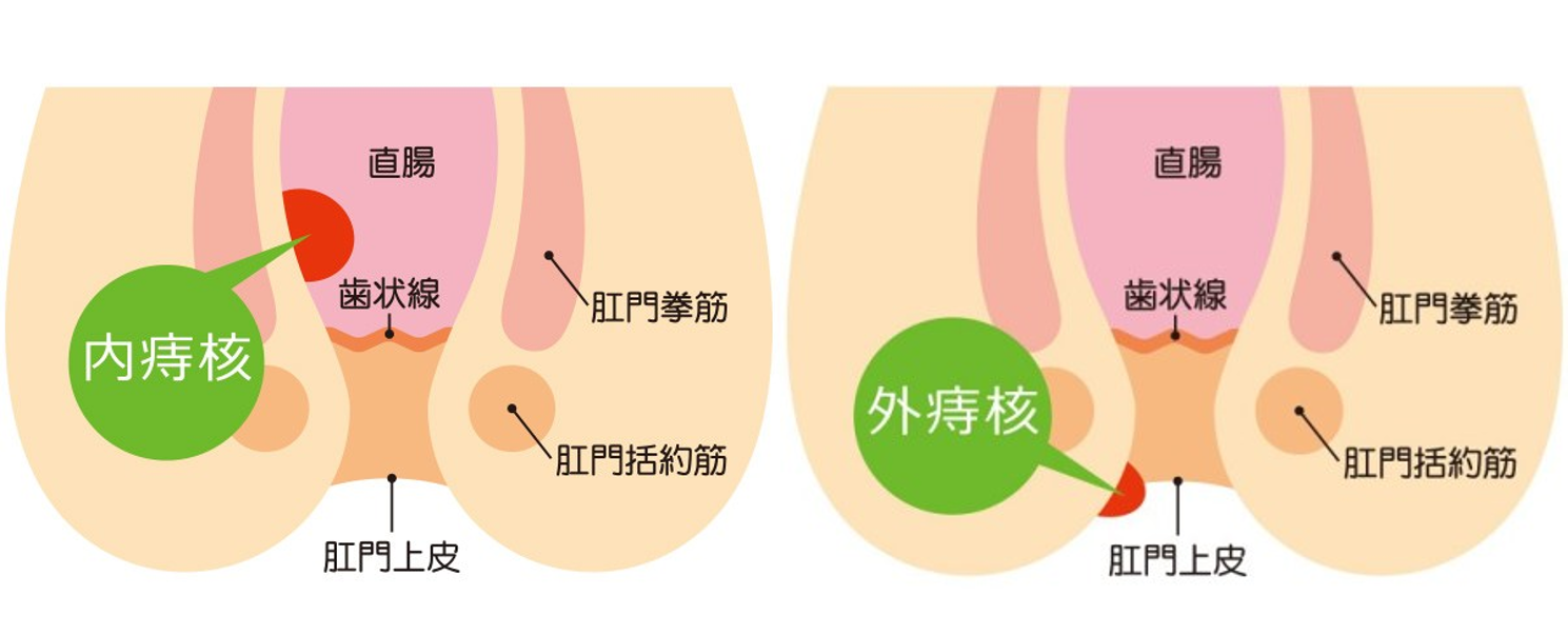 痔核（イボ痔）