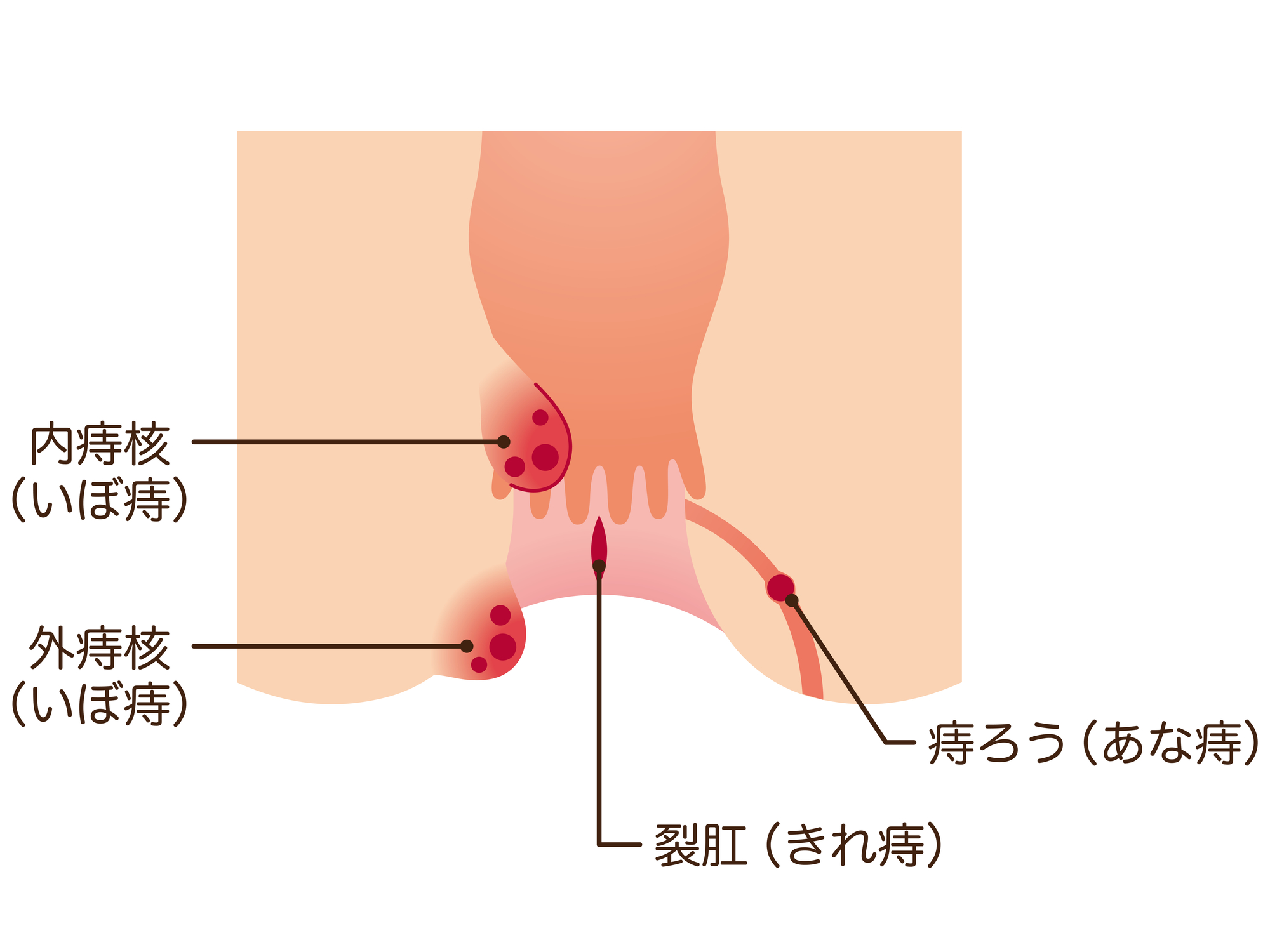 痔について