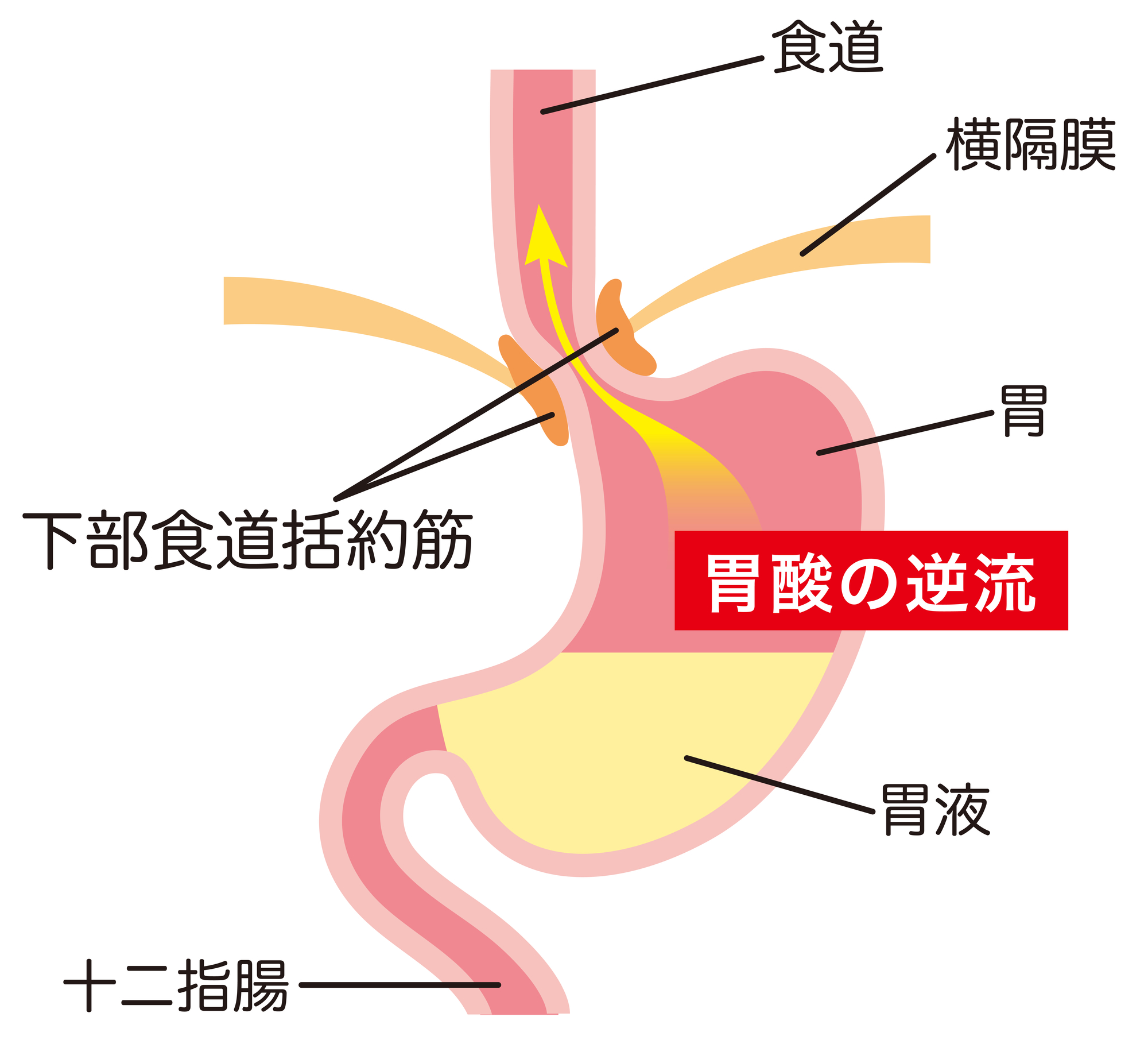 逆流性食道炎について