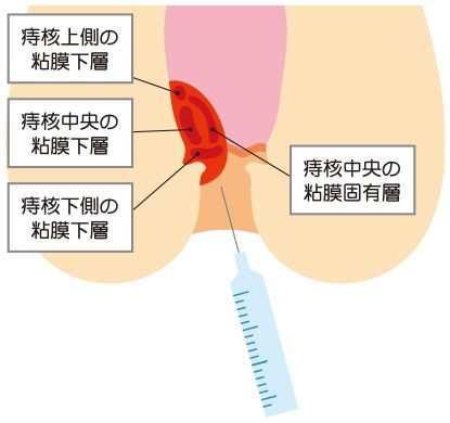 肛門疾患（痔核、痔ろう、裂肛など）